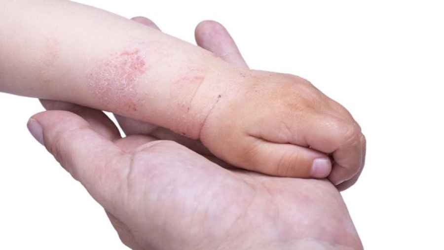 Aprueban el uso en niños de un tratamiento innovador para la dermatitis