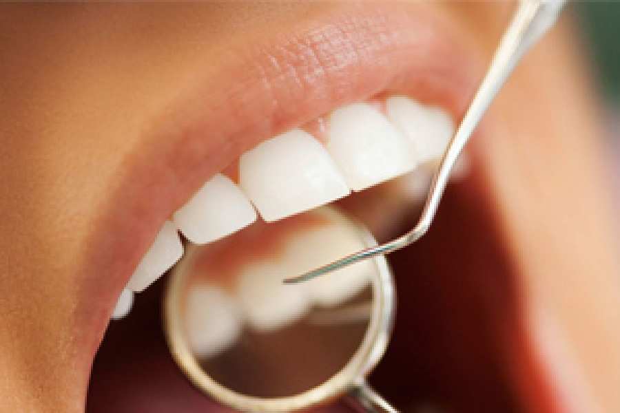 Los cambios inducidos por la diabetes en la composici&oacute;n de la flora bucodental conllevan alteraciones inflamatorias que promueven la p&eacute;rdida &oacute;sea asociada a la periodontitis.