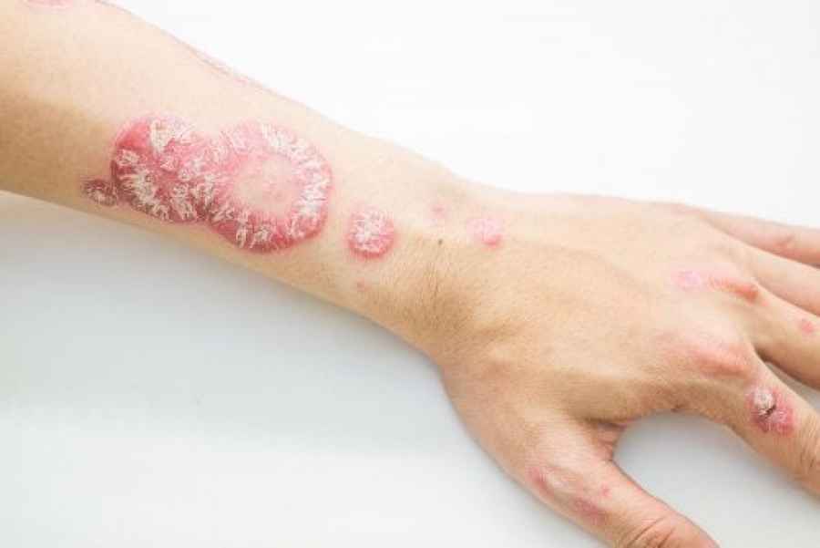 Janssen presenta nuevo fármaco para la psoriasis