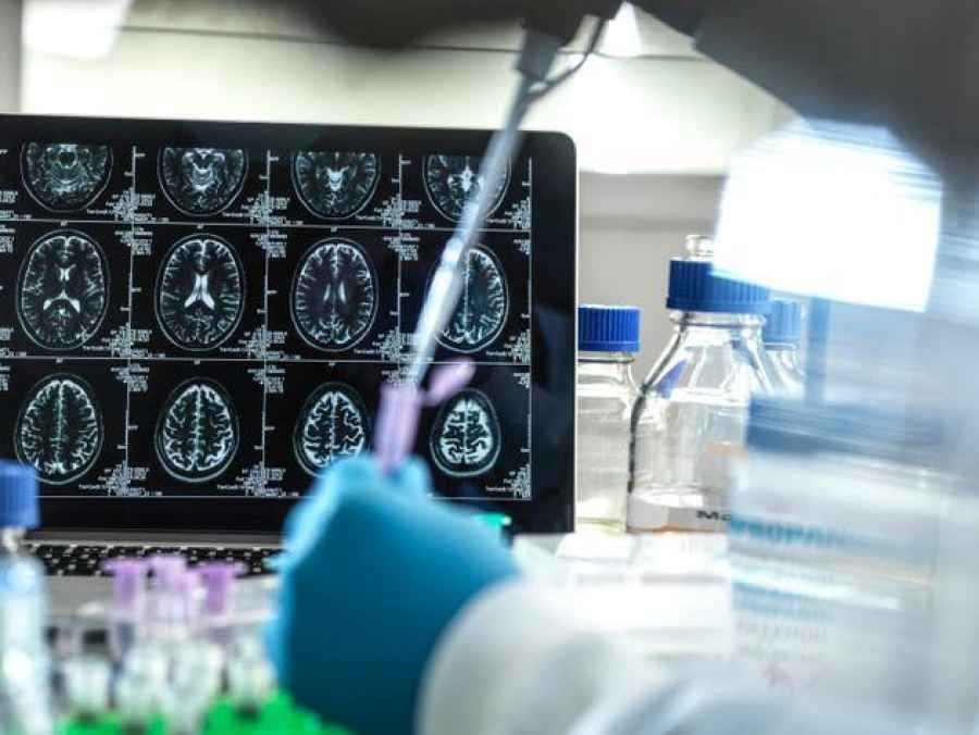 Hallan 75 regiones del genoma relacionadas con el Alzheimer