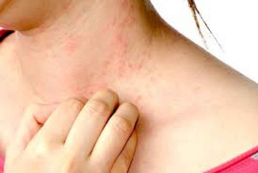 Urticaria Cr&oacute;nica Espont&aacute;nea: la clave es el diagn&oacute;stico
