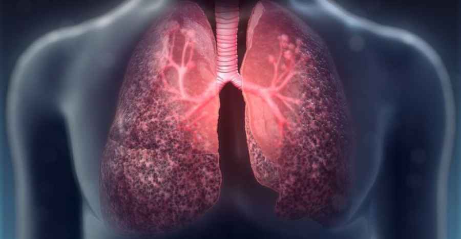 Nuevo enfoque para tratar la fibrosis qu&iacute;stica