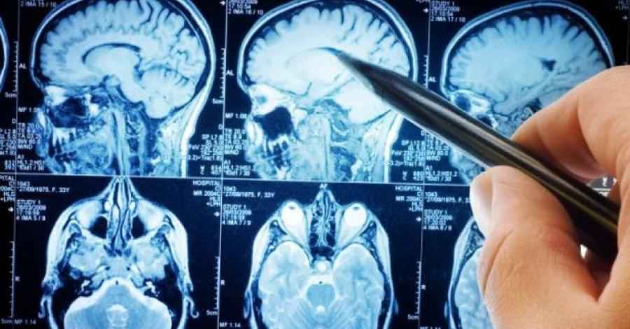 ANMAT aprueba Cladribina 10 mg para tratamiento de la esclerosis m&uacute;ltiple