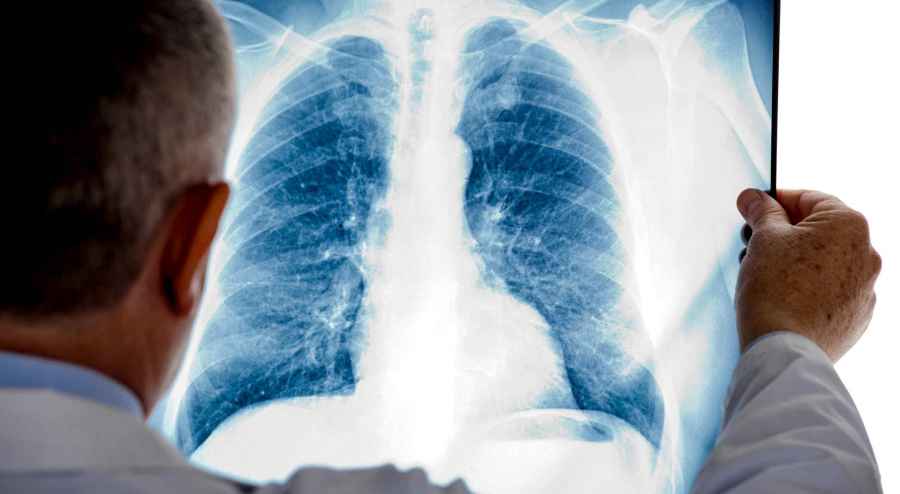 Aprobaci&oacute;n de ANMAT de dos inmunoterapias en primera l&iacute;nea