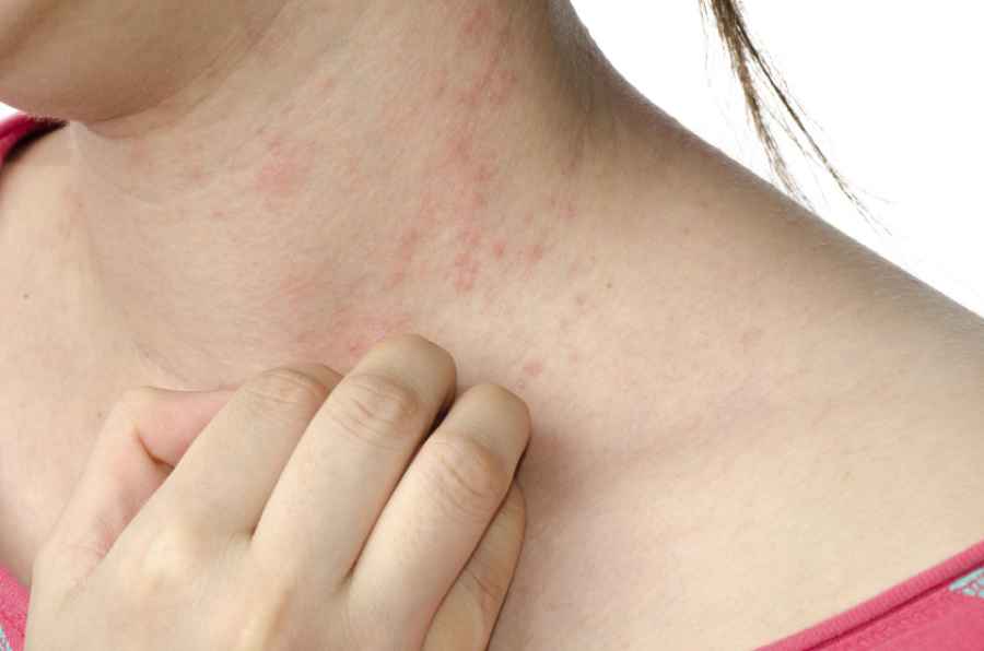 Dermatitis at&oacute;pica en adolescentes, una consulta prevalente