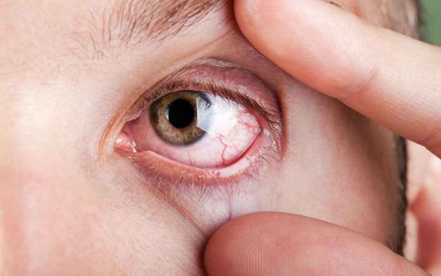 Hipotiroidismo y enfermedad ocular