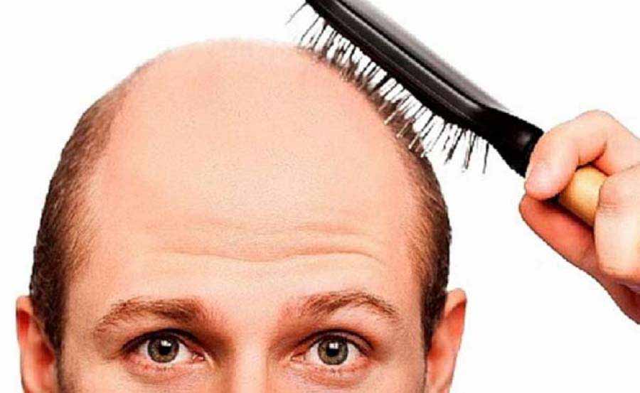 La alopecia androgénica afecta a cerca del 50% de personas a partir de los 50 años. En la mayoría de casos se trata de una desafortunada combinación de factores fisiológicos y carga genética 