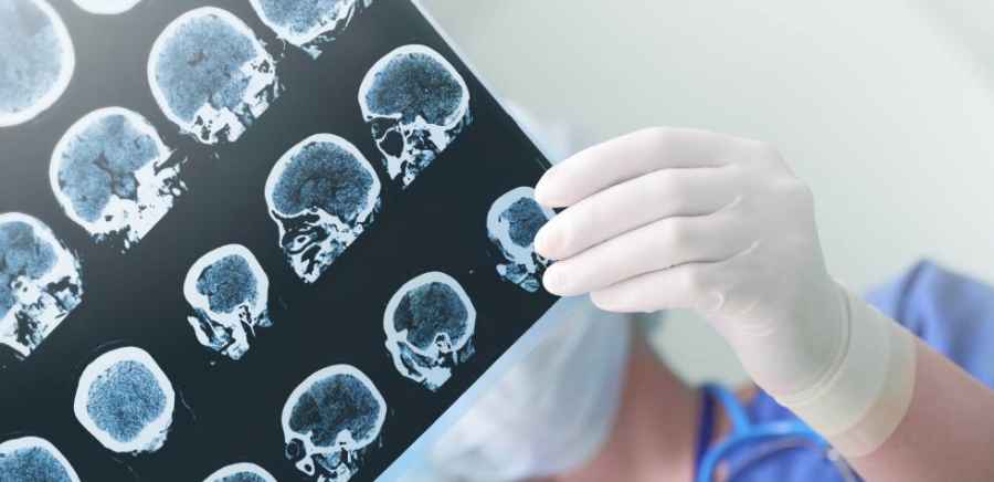 Tomar antihipertensivos y estatinas reduce casi a la mitad el riesgo de un primer ictus