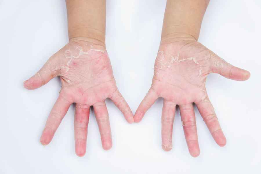 Impacto de la dermatitis atópica en niños