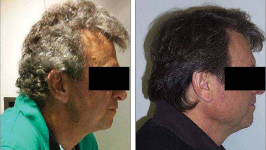 F&aacute;rmaco contra el c&aacute;ncer logra repigmentar las canas