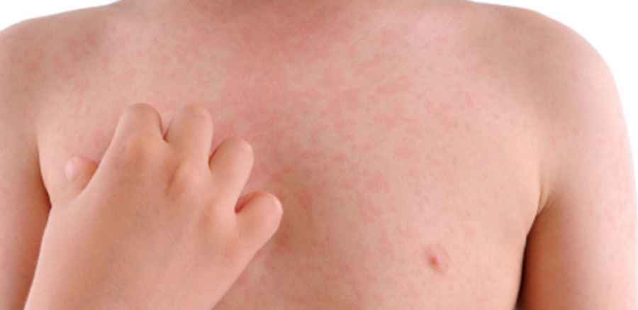 URTICARIA CRÓNICA ESPONTÁNEA:  UNA ENFERMEDAD QUE AFECTA A MÁS DE 100.000 ARGENTINOS