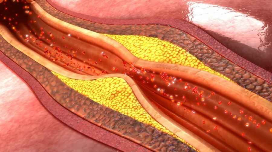 La enfermedad cardiovascular constituye una de las principales causas de mortalidad en adultos en países occidentales