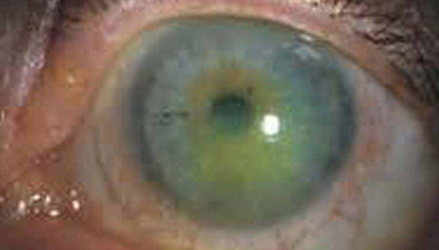 Las gotas oft&aacute;lmicas de Cenegermin reciben la aprobaci&oacute;n europea