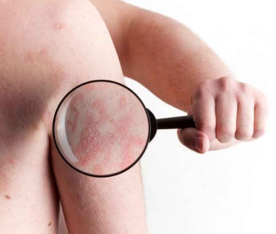 Nueva alternativa terapéutica en psoriasis