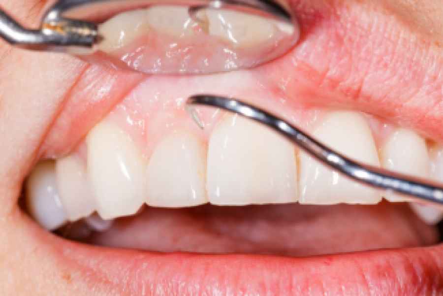 Una prote&iacute;na presente en la enc&iacute;a podr&iacute;a ayudar a prevenir el Alzh&eacute;imer