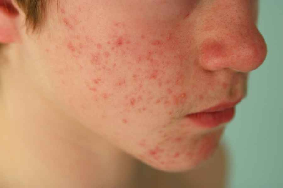 Aprueban la indicación en adolescentes de medicamento para dermatitis atópica severa